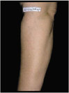 arm-after.jpg
